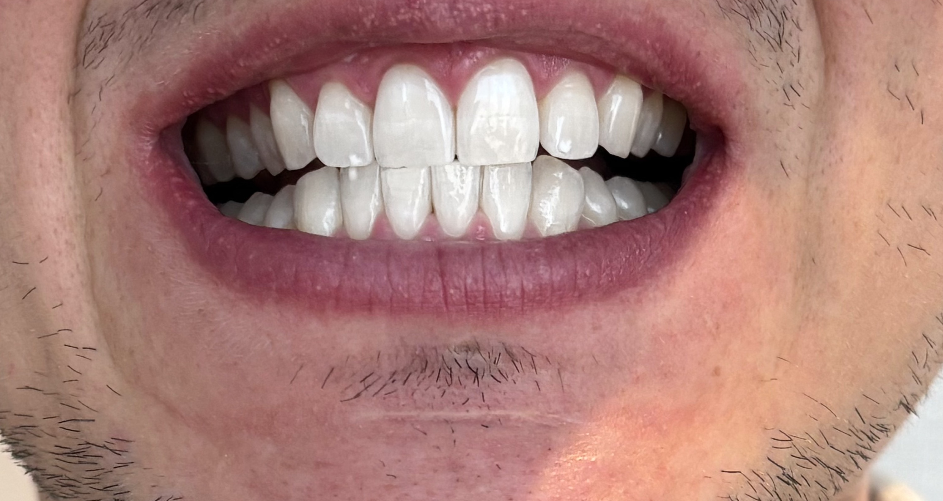 After — Same-client professional teeth whitening transformation